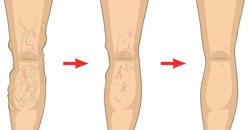 Variquit funciona